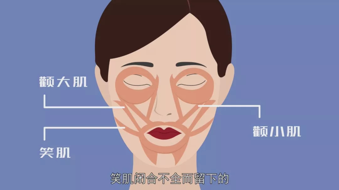 有研究认为,酒窝是一种生理缺陷,是由于面部颧大肌,颧小肌,笑肌闭合