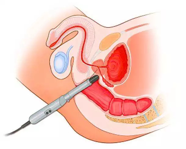 前列腺穿刺部位示意图图片