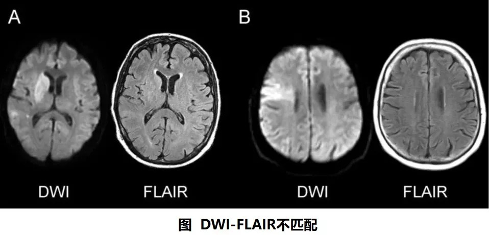 flair磁共振图片