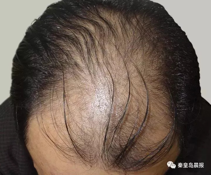 由基因,激素水平导致的雄激素性脱发,也叫男性型脱发