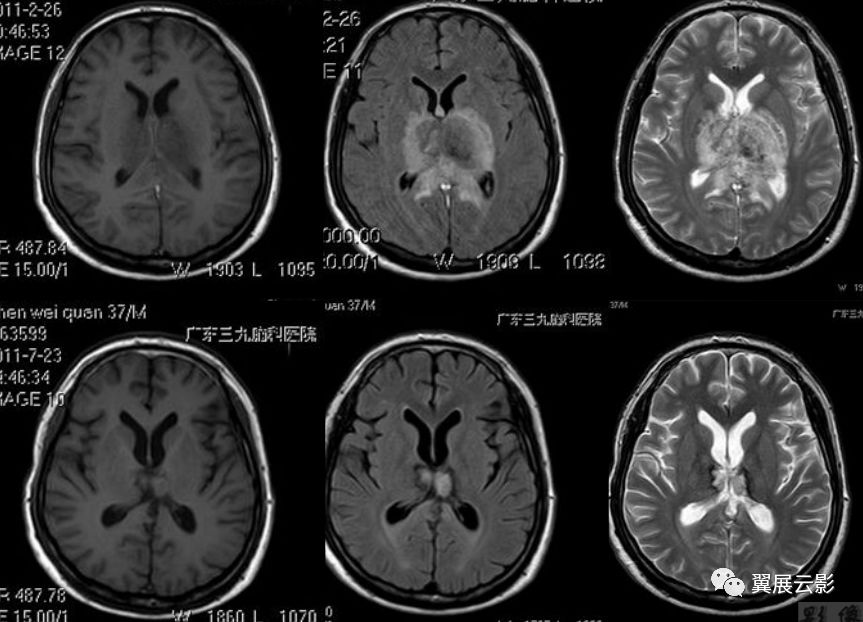 基底节区及丘脑对称性病变mri诊断
