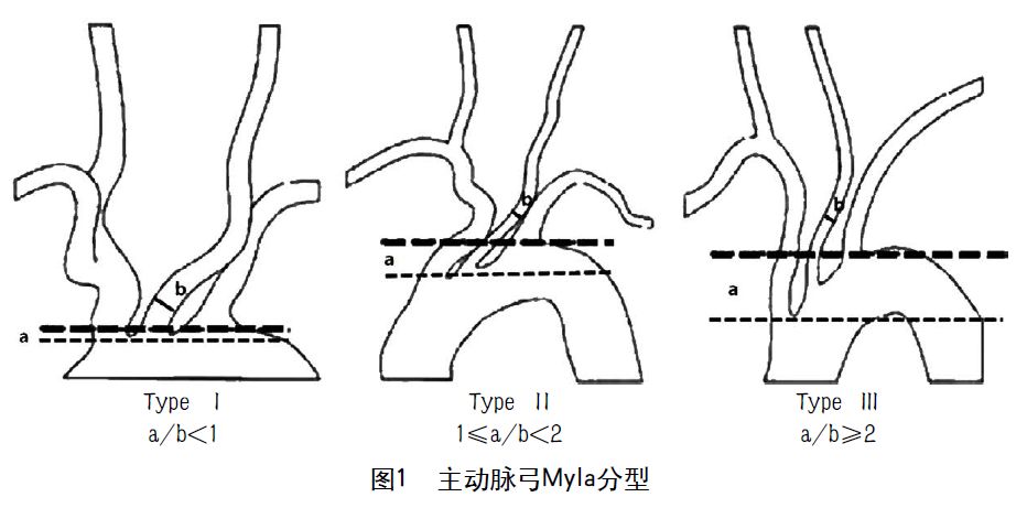 主动脉弓离断分型图片