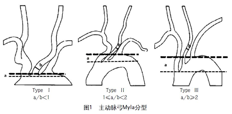 主动脉弓一型二型三型图片