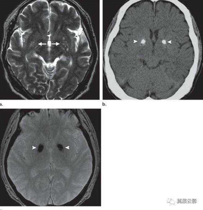 基底节区及丘脑对称性病变mri诊断