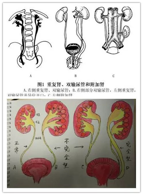 重複腎是由於胚胎髮育第四周時,輸尿管芽有終身管發出,並迅速向頭端