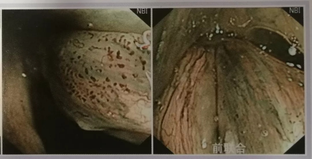 嗓子哑了1个月窄带成像技术nbi发现竟是声带癌