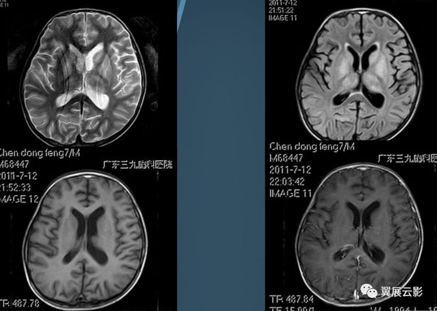 基底节区及丘脑对称性病变mri诊断