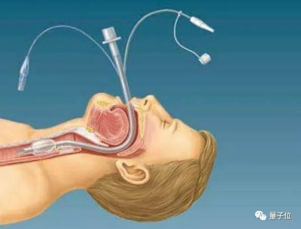 气管插管图片卡通图片