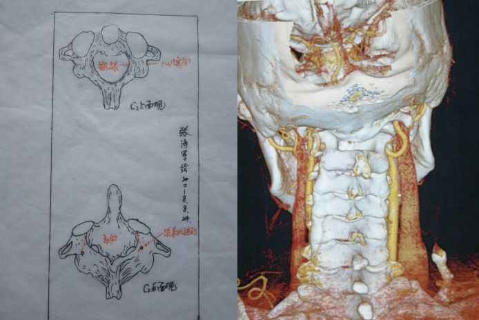 图4(枢椎和椎动脉走形情况)图5(c1和c2椎体及置钉点)枕颈固定融合关键