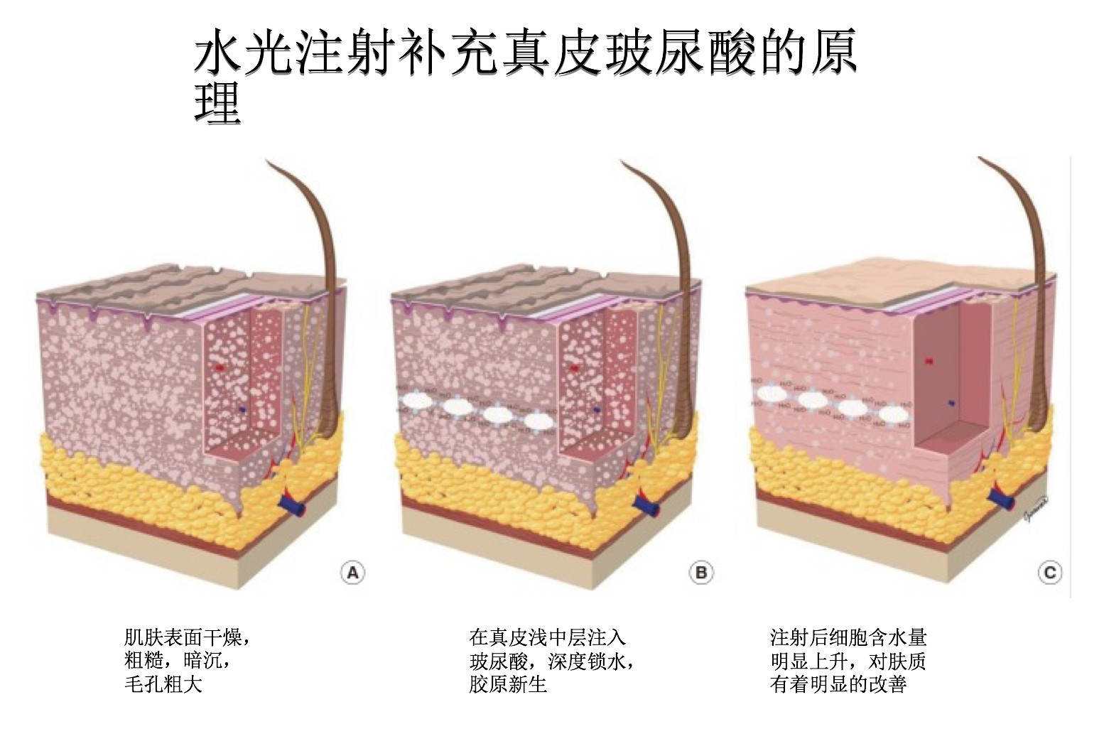 中胚层治疗——你了解真正的水光针吗?