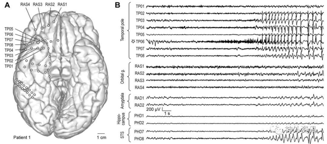 顳葉癲癇與顳極腦電活動相關