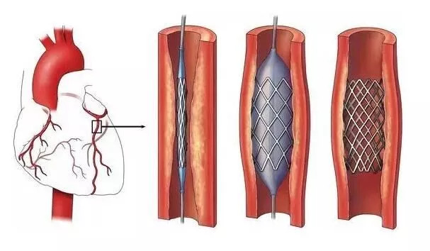 冠状动脉内支架植入术怎么做？