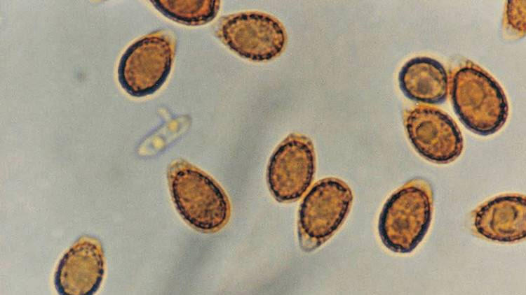 灵芝孢子被误诊为肠寄生虫卵