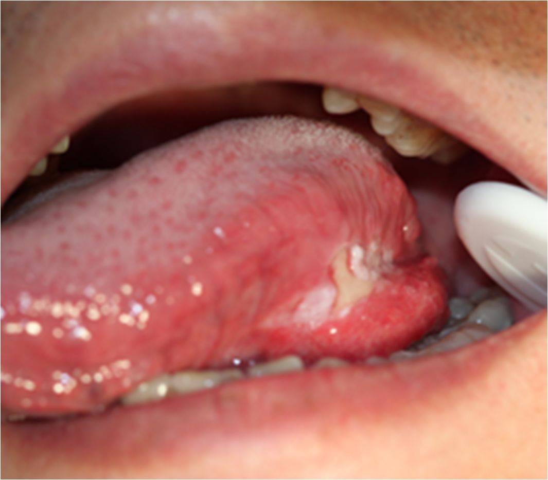 舌头溃疡照片图片