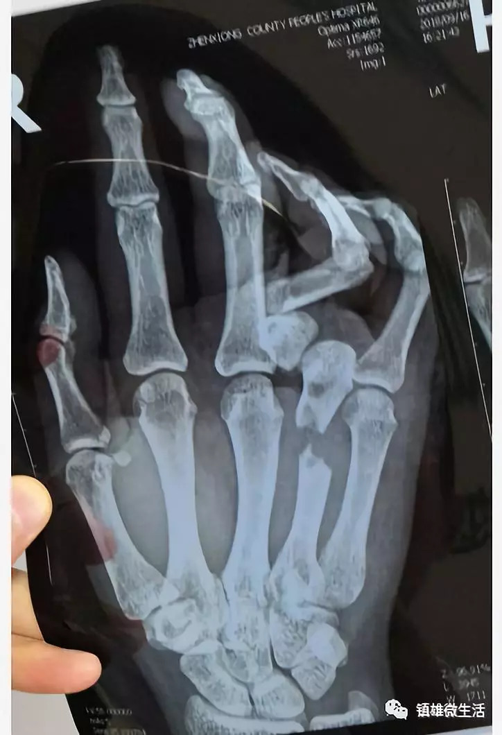 手指骨折片子真实图图片