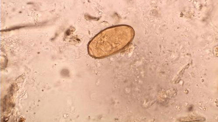 灵芝孢子被误诊为肠寄生虫卵