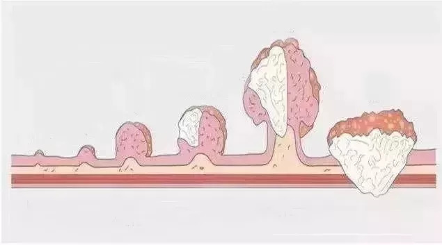 【提示】別把腺瘤不當瘤