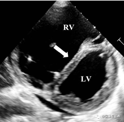 图8:经胸超声在胸骨旁短轴切面显示收缩期时由于急性右心室压力增加