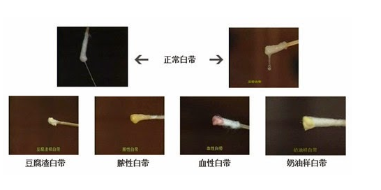 霉菌感染分泌物图片图片