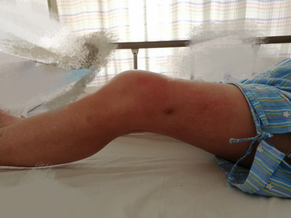 病例分享下肢制动致膝关节僵硬的康复治疗