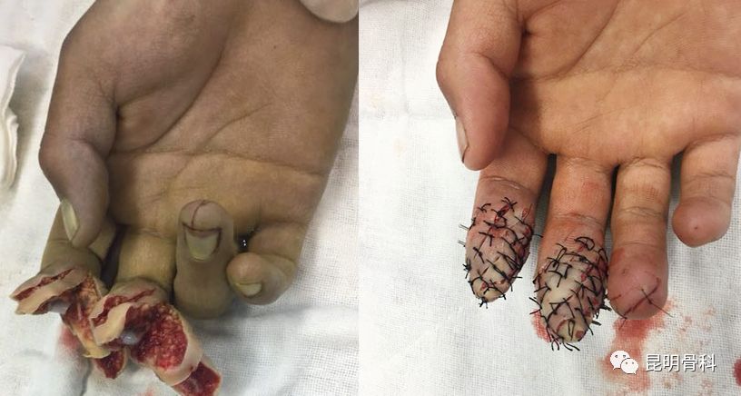 手指残端手术示意图图片