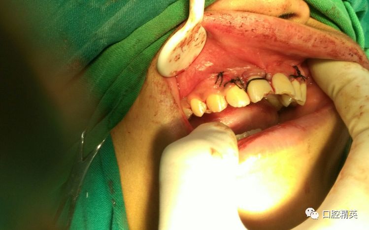 上前牙根尖外科手术