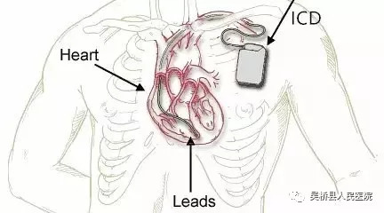 植入式心脏复律除颤器图片