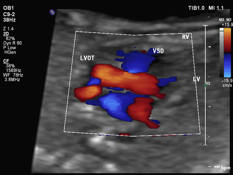图三:3vv切面可见狭窄的主肺动脉