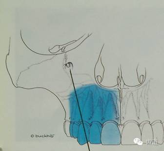 上颌6麻醉解剖图图片