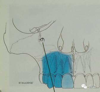 口腔麻醉进针点图片