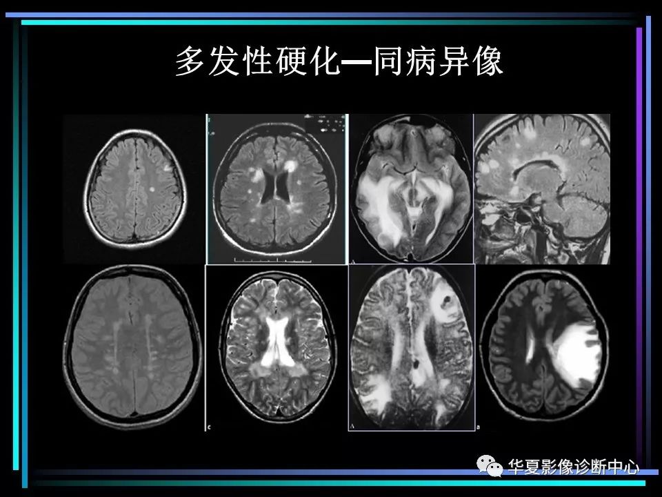 多发性硬化影像学诊断简版