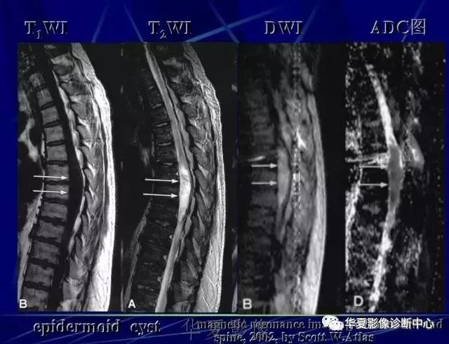 表皮囊肿黑色图片