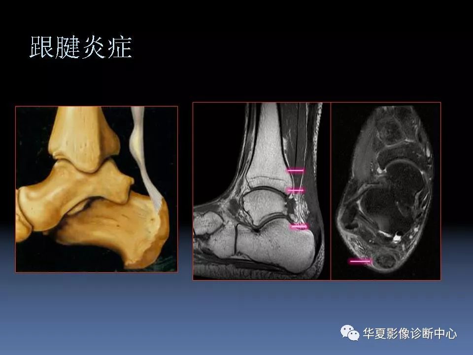 踝關節mri解剖及常見病變