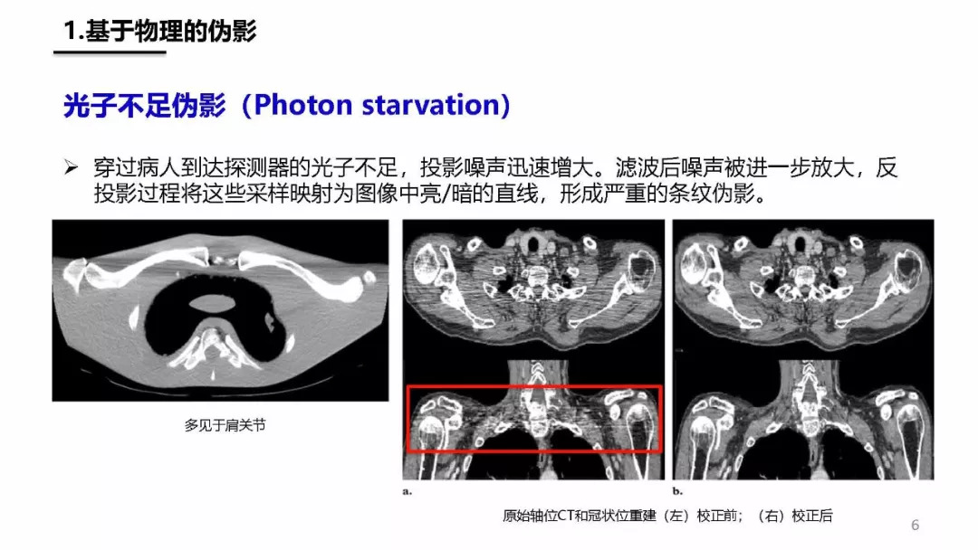 ct偽影產生機制及圖像表現