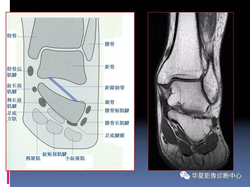 踝关节mri解剖及常见病变