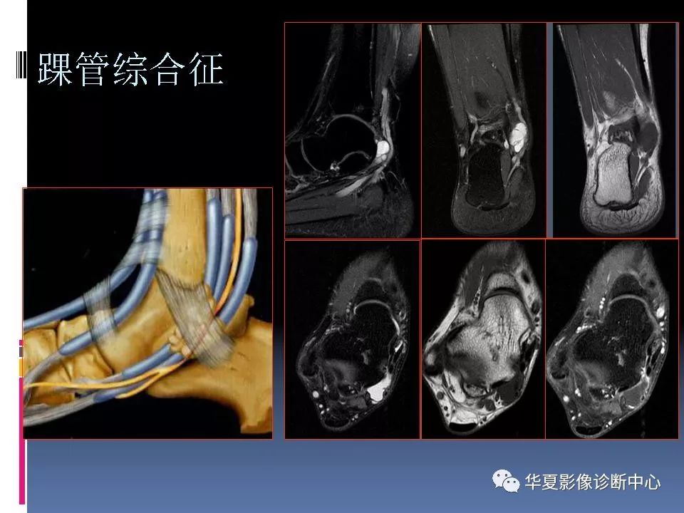 踝關節mri解剖及常見病變