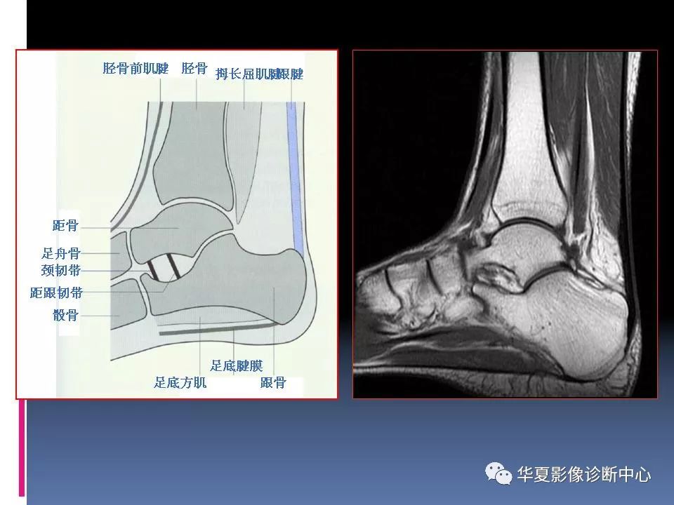 踝關節mri解剖及常見病變