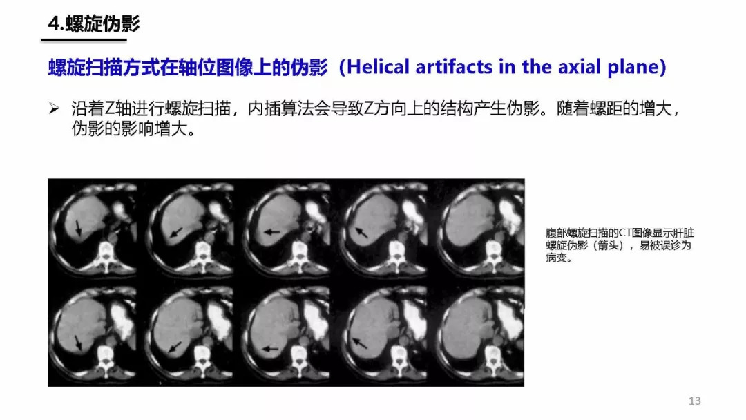 ct伪影产生机制及图像表现