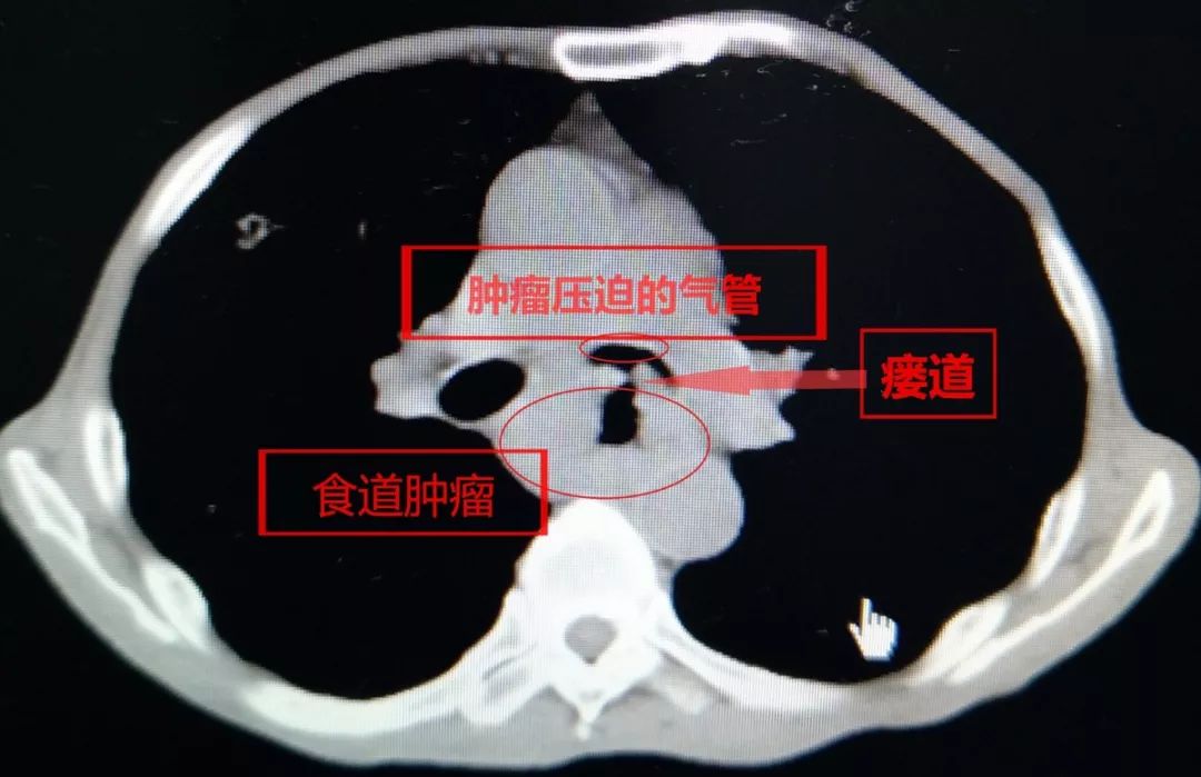 食管气管瘘影像学表现图片