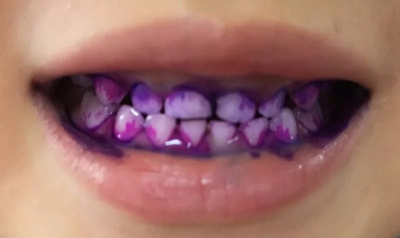 为什么牙龈是乌紫色的图片
