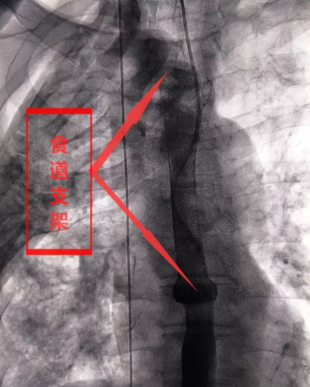 武钢二医院成功为一位食管癌合并食道气管瘘的患者安装食道覆膜支架