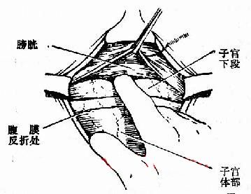 产科经典手术剖宫产手术步骤超详细图解值得收藏