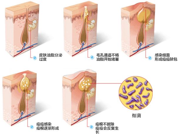 痘痘反覆生長,那是痘根在作怪!