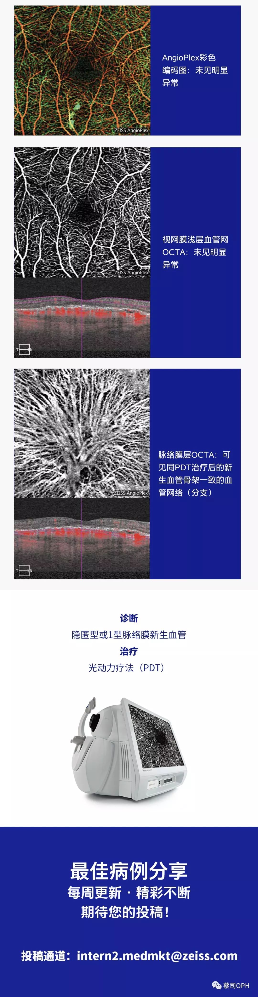 每周最佳病例分享 隐匿型或1型脉络膜新生血管 pdt治疗后