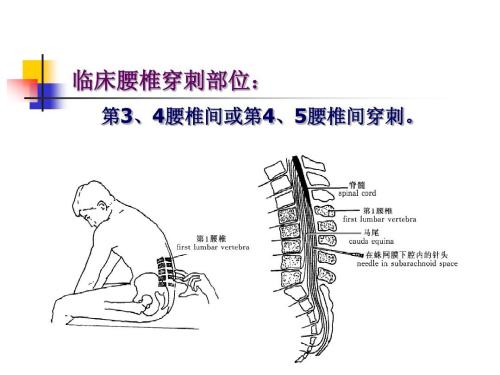 就诊指南如何正确认识腰椎穿刺