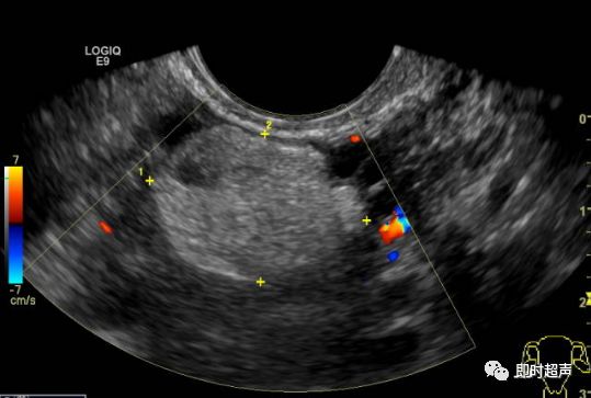超声畸胎瘤8种声像图图片