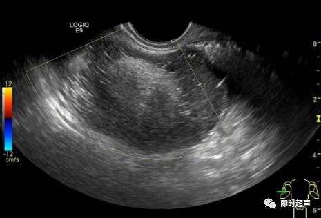 卵巢畸胎瘤超声图像图片
