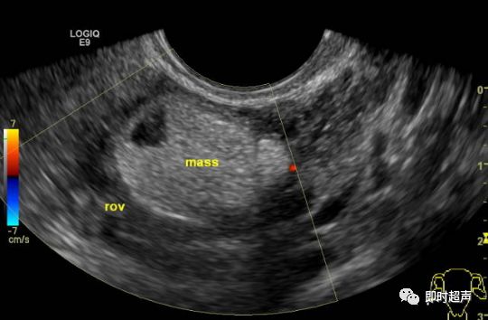 超声畸胎瘤8种声像图图片