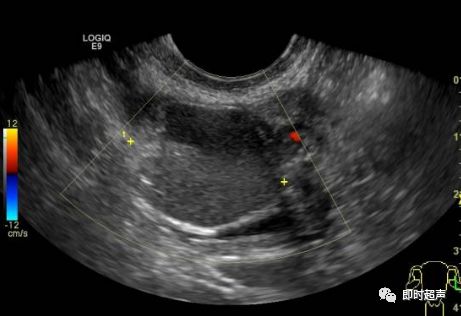 卵巢畸胎瘤超声图像图片