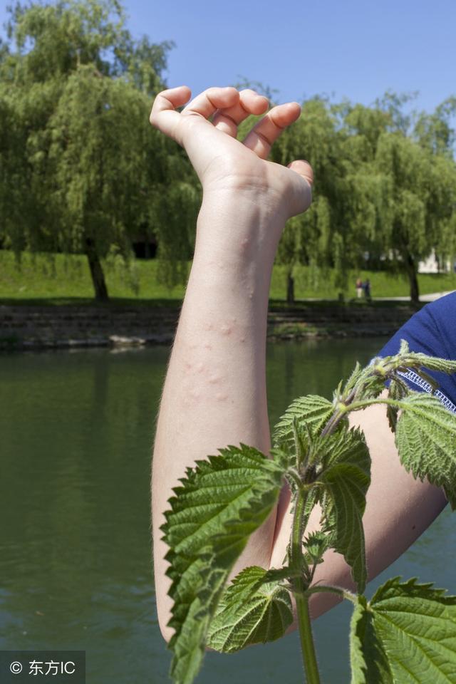 荨麻草蜇人后图片图片